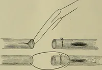 An illustration from Modern surgery, general and operative / by John Chalmers DaCosta. (1914)