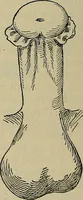 An illustration from Modern surgery, general and operative / by John Chalmers DaCosta. (1914)