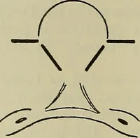 An illustration from Modern surgery, general and operative / by John Chalmers DaCosta. (1914)