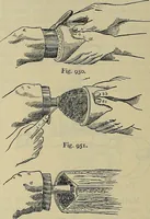 An illustration from Modern surgery, general and operative / by John Chalmers DaCosta. (1914)