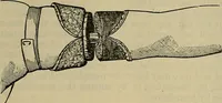 An illustration from Modern surgery, general and operative / by John Chalmers DaCosta. (1914)
