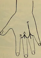 An illustration from Modern surgery, general and operative / by John Chalmers DaCosta. (1914)