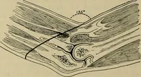 An illustration from Modern surgery, general and operative / by John Chalmers DaCosta. (1914)