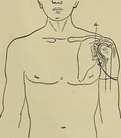 An illustration from Modern surgery, general and operative / by John Chalmers DaCosta. (1914)