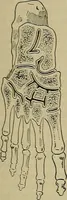 An illustration from Modern surgery, general and operative / by John Chalmers DaCosta. (1914)