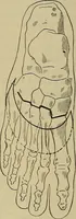 An illustration from Modern surgery, general and operative / by John Chalmers DaCosta. (1914)
