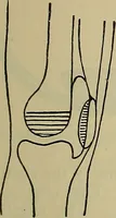 An illustration from Modern surgery, general and operative / by John Chalmers DaCosta. (1914)