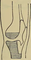 An illustration from Modern surgery, general and operative / by John Chalmers DaCosta. (1914)