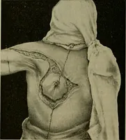 An illustration from Modern surgery, general and operative / by John Chalmers DaCosta. (1914)