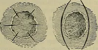 An illustration from Modern surgery, general and operative / by John Chalmers DaCosta. (1914)