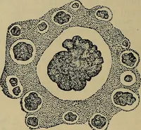 An illustration from Modern surgery, general and operative / by John Chalmers DaCosta. (1914)