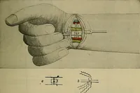 An illustration from Modern surgery, general and operative / by John Chalmers DaCosta. (1914)