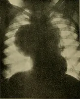 An illustration from Modern surgery, general and operative / by John Chalmers DaCosta. (1914)