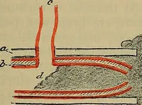 An illustration from Modern surgery, general and operative / by John Chalmers DaCosta. (1914)