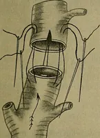 An illustration from Modern surgery, general and operative / by John Chalmers DaCosta. (1914)
