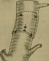 An illustration from Modern surgery, general and operative / by John Chalmers DaCosta. (1914)