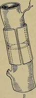 An illustration from Modern surgery, general and operative / by John Chalmers DaCosta. (1914)