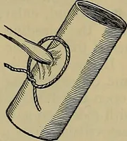 An illustration from Modern surgery, general and operative / by John Chalmers DaCosta. (1914)