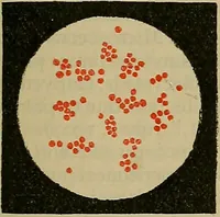An illustration from Modern surgery, general and operative / by John Chalmers DaCosta. (1914)
