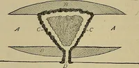 An illustration from Modern surgery, general and operative / by John Chalmers DaCosta. (1914)