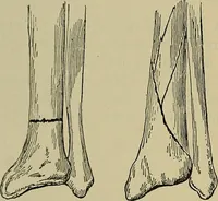 An illustration from Modern surgery, general and operative / by John Chalmers DaCosta. (1914)