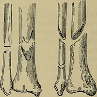 An illustration from Modern surgery, general and operative / by John Chalmers DaCosta. (1914)