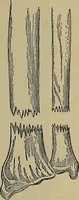 An illustration from Modern surgery, general and operative / by John Chalmers DaCosta. (1914)