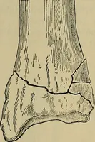 An illustration from Modern surgery, general and operative / by John Chalmers DaCosta. (1914)