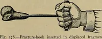 An illustration from Modern surgery, general and operative / by John Chalmers DaCosta. (1914)