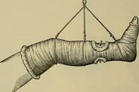 An illustration from Modern surgery, general and operative / by John Chalmers DaCosta. (1914)