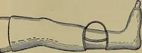 An illustration from Modern surgery, general and operative / by John Chalmers DaCosta. (1914)