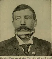 An illustration from Modern surgery, general and operative / by John Chalmers DaCosta. (1914)
