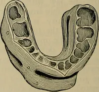 An illustration from Modern surgery, general and operative / by John Chalmers DaCosta. (1914)
