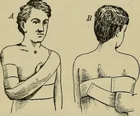 An illustration from Modern surgery, general and operative / by John Chalmers DaCosta. (1914)