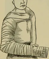 An illustration from Modern surgery, general and operative / by John Chalmers DaCosta. (1914)