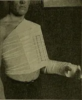 An illustration from Modern surgery, general and operative / by John Chalmers DaCosta. (1914)