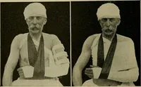 An illustration from Modern surgery, general and operative / by John Chalmers DaCosta. (1914)