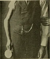 An illustration from Modern surgery, general and operative / by John Chalmers DaCosta. (1914)
