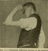 An illustration from Modern surgery, general and operative / by John Chalmers DaCosta. (1914)