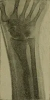 An illustration from Modern surgery, general and operative / by John Chalmers DaCosta. (1914)