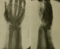An illustration from Modern surgery, general and operative / by John Chalmers DaCosta. (1914)