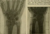 An illustration from Modern surgery, general and operative / by John Chalmers DaCosta. (1914)