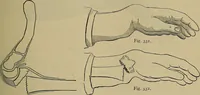 An illustration from Modern surgery, general and operative / by John Chalmers DaCosta. (1914)