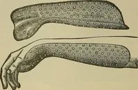 An illustration from Modern surgery, general and operative / by John Chalmers DaCosta. (1914)