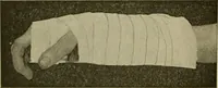 An illustration from Modern surgery, general and operative / by John Chalmers DaCosta. (1914)