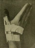 An illustration from Modern surgery, general and operative / by John Chalmers DaCosta. (1914)