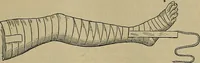 An illustration from Modern surgery, general and operative / by John Chalmers DaCosta. (1914)