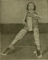 An illustration from Modern surgery, general and operative / by John Chalmers DaCosta. (1914)
