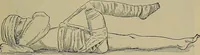 An illustration from Modern surgery, general and operative / by John Chalmers DaCosta. (1914)