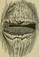 An illustration from Modern surgery, general and operative / by John Chalmers DaCosta. (1914)